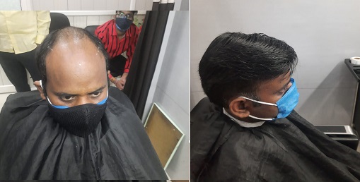 Non Surgical Hair Replacement Service in Delhi